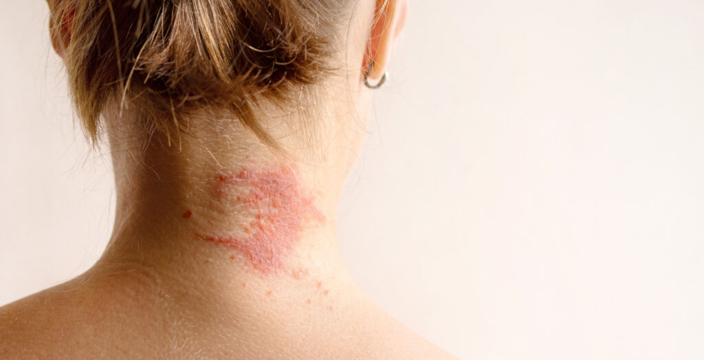 Manifestation,Of,Atopic,Dermatitis,As,A,Red,Itchy,Spot,On