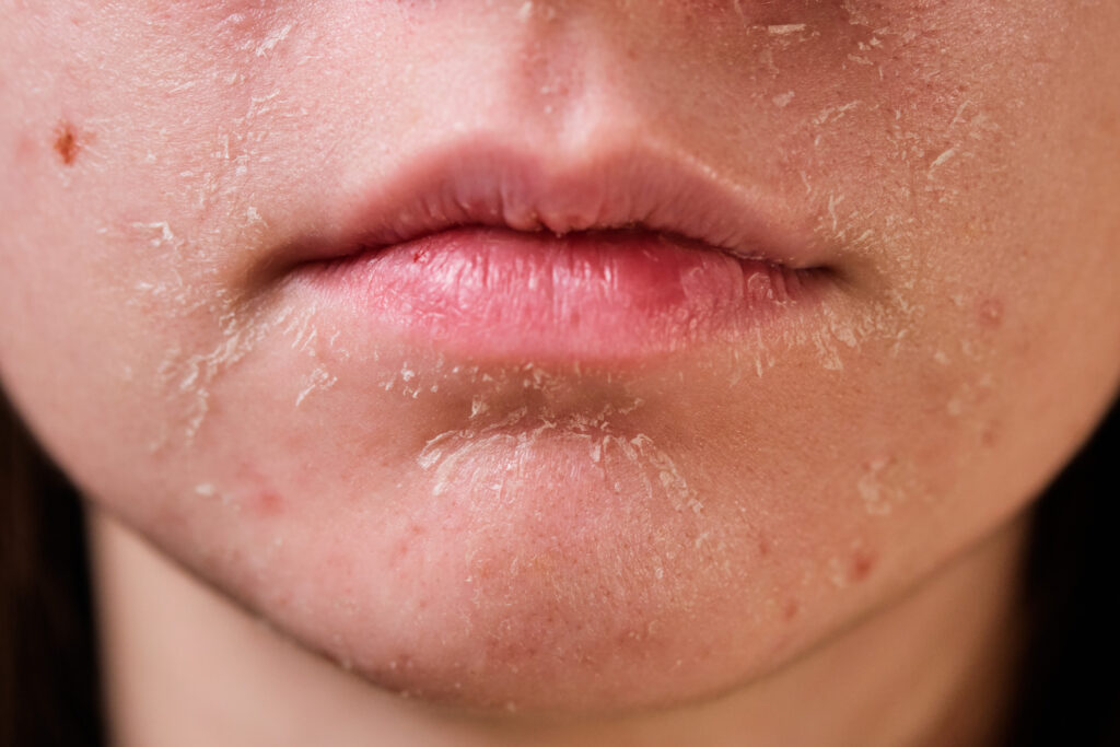 Come trattare la pelle secca pelle disidratata beauty routine